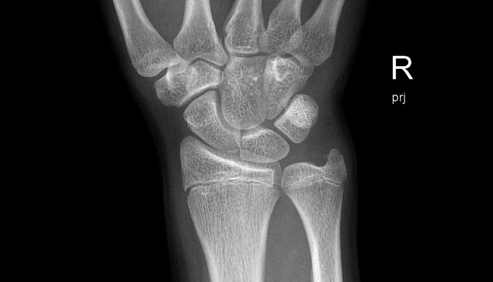 Joy broke her wrist